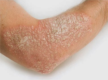 Atopichesky la dermatitis la crema emolium